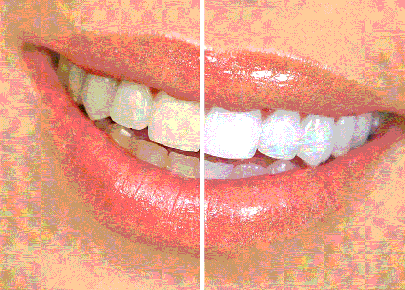 HYSMILE™-Pasta Dental Blanqueadora V34